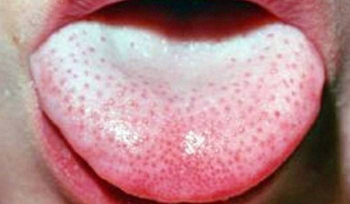 Білий наліт на язиці - причини появи у дорослих і дітей, лікування, фото
