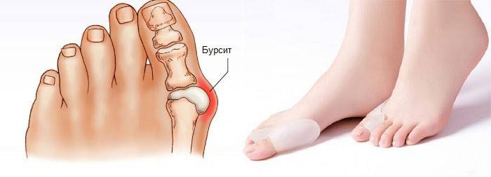 Бурсит великого пальця стопи - лікування, симптоми, фото до і після операції
