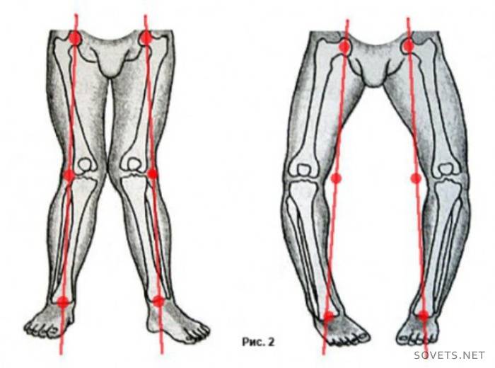 Лікування артрозу колінного суглоба народними засобами, гімнастика, ЛФК, фото і відео