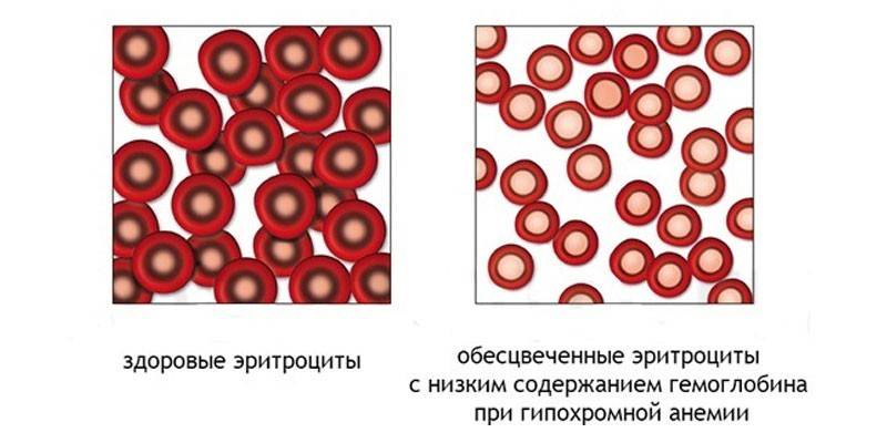 Гіпохромія в загальному аналізі крові: причини зміни показників