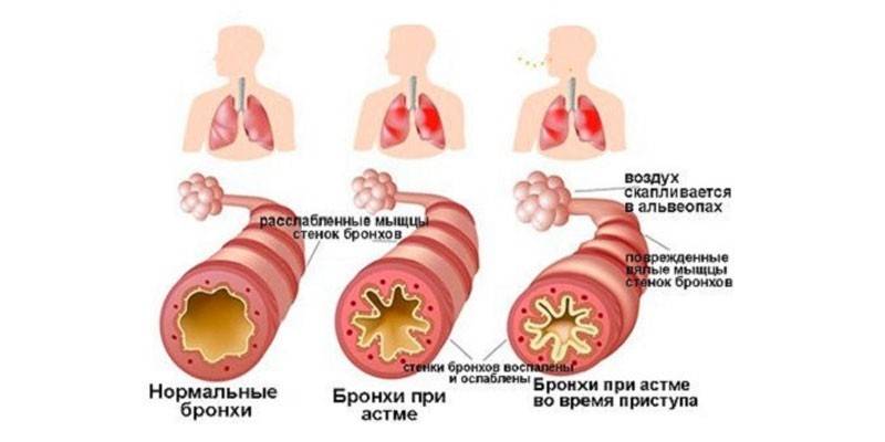 Бронхоспазм - симптоми і причини