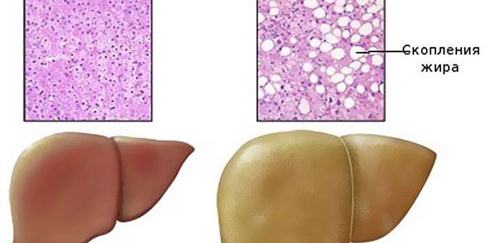 Жировий гепатоз печінки - симптоми і лікування народними засобами і ліками