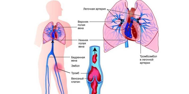 Тромбоемболія легеневої артерії - симптоми захворювання