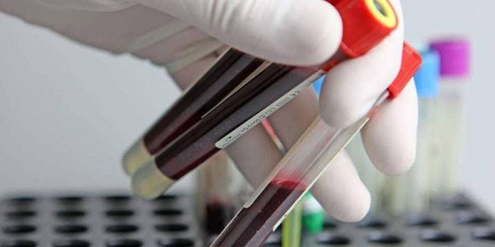 С-реактивний білок в аналізі крові - норма для дітей і дорослих і як підвищити показник