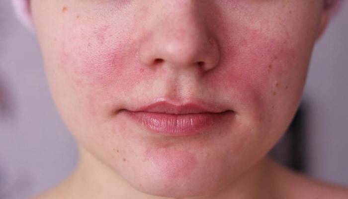 Лікування куперозу на обличчі в домашніх умовах і лазером, причини появи