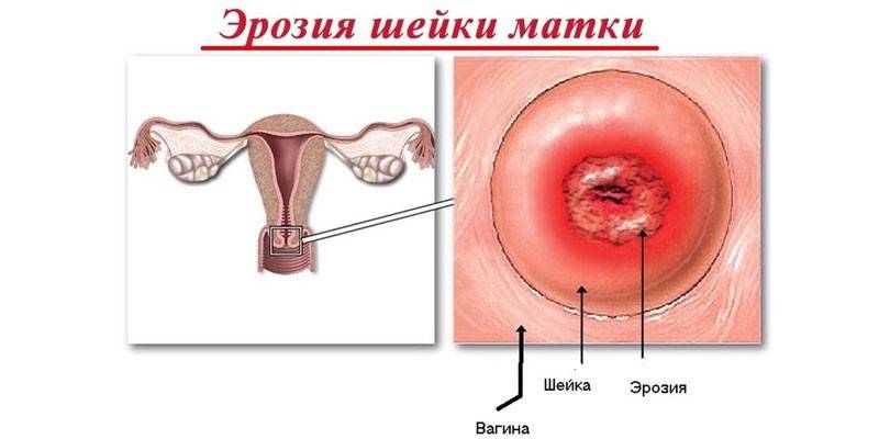 Ерозія шийки матки - симптоми у жінок