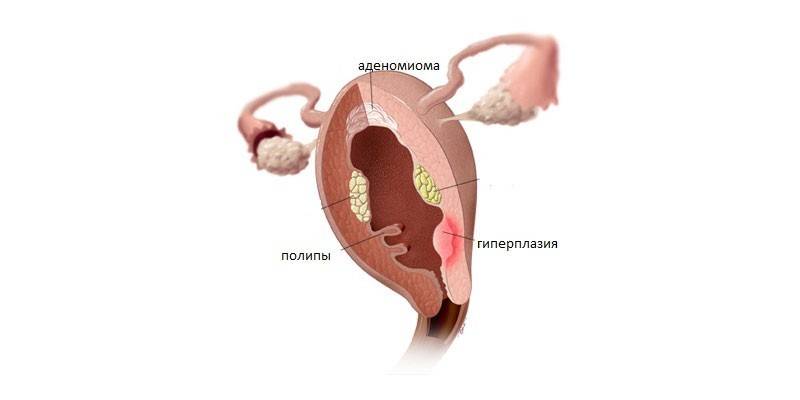 Гіперплазія ендометрія - симптоми у жінок