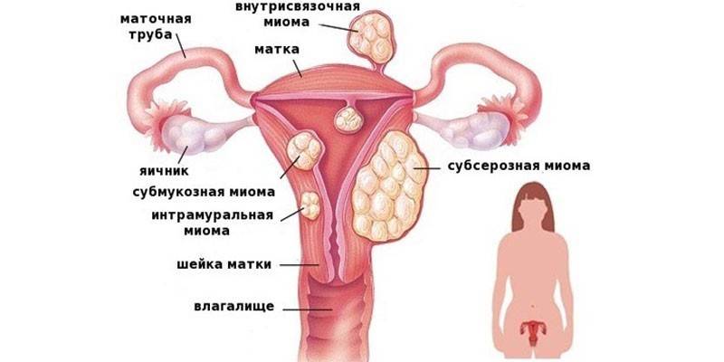 Міома при вагітності: чи небезпечна пухлина в матці