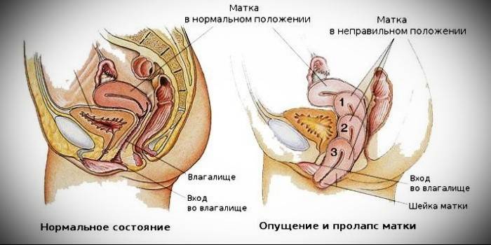 Опущення матки - ознаки та небезпека патології, УЗД-діагностика і терапія