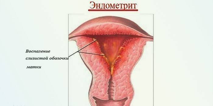 Хронічний ендометрит - симптоми запалення, як діагностують і лікують, наслідки та профілактика