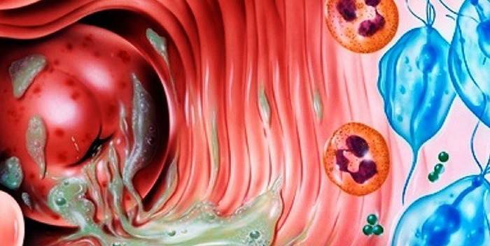 Бактеріальний вагініт: причини, стадії та види захворювання, препарати та народні засоби від запалення слизової оболонки піхви