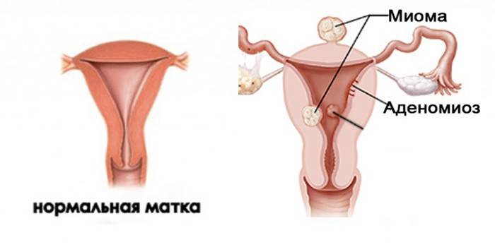 Міома матки - розміри для операції та показання до видалення