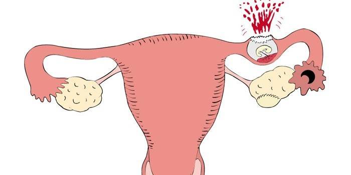 Причини позаматкової вагітності - як виникає і розвивається у жінок на ранніх строках