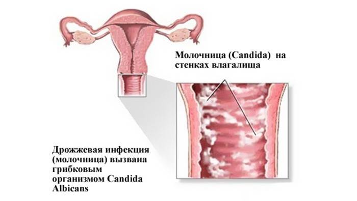 Молочниця у жінок - симптоми і лікування, причини виникнення, відео