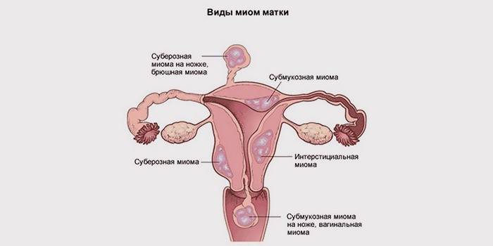 Міома матки: лікування народними засобами ефективно і без операції