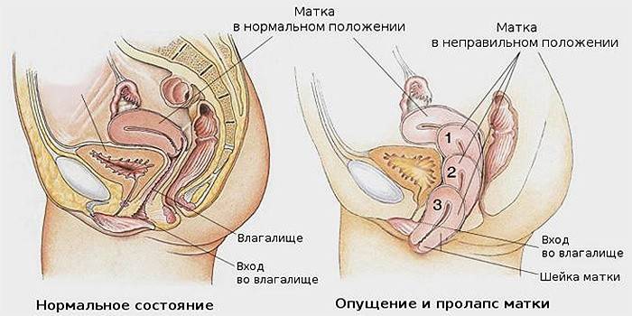 Випадання матки у жінок в літньому віці: лікування та операція шийки