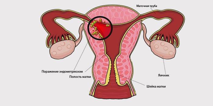 Ендометріоз – симптоми і лікування матки народними засобами