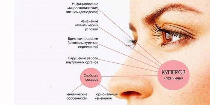 Судинні зірочки на обличчі - лікування апаратними або народними способами