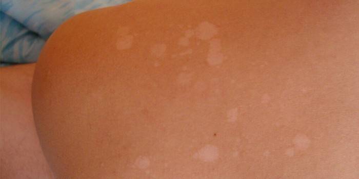 Білі плями на шкірі після засмаги - способи лікування та профілактика