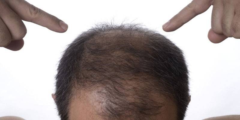 Дифузна алопеція: причини випадіння волосся і лікування