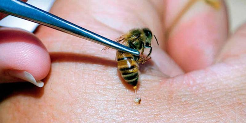 Вкусила бджола – що робити в домашніх умовах, як і чим обробити місце укусу