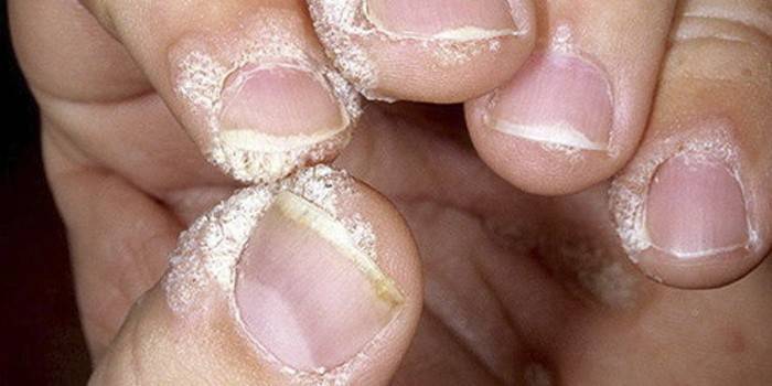 Лікування грибка нігтів - запущена форма на руках і ногах