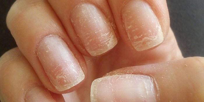 Як швидко позбутися від грибка нігтів: як лікувати захворювання
