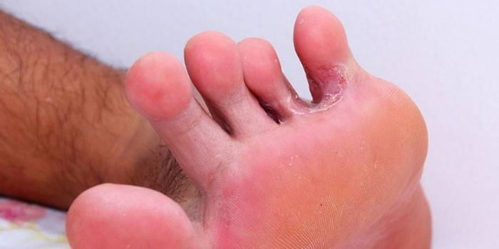 Лікування грибка на нігтях пальців ніг в домашніх умовах