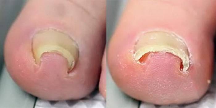 Як видалити врослий ніготь: методи лікування нігтьової пластини від онихокриптоза