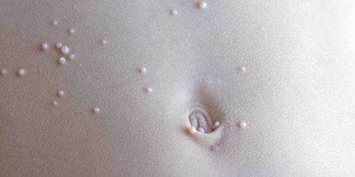 Молюск на шкірі у дитини: шляхи зараження і симптоми захворювання, видалення вірусних вузликів на тілі