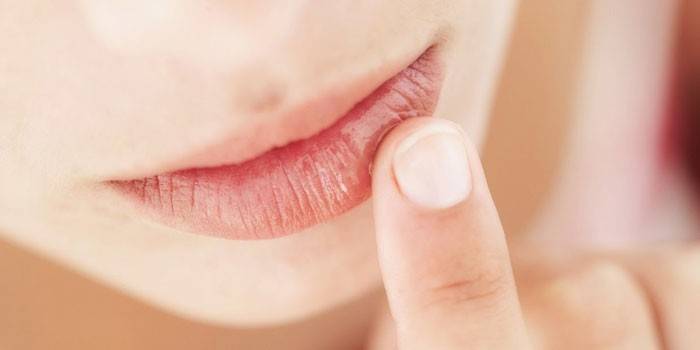 Грибок на губах: як лікувати