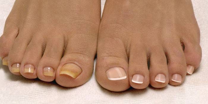Комплексне лікування грибка нігтів на ногах у домашніх умовах - ефективні схеми і способи