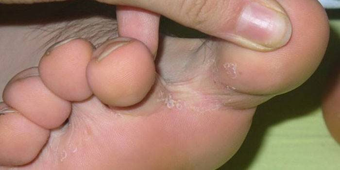 Ознаки грибка на ногах - різновиди і як визначити за першим симптомів початок захворювання