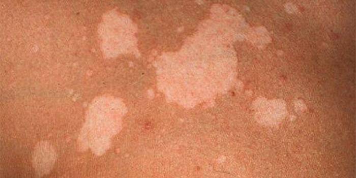 Грибок на спині - чому з'являється на шкірі у дітей і дорослих, перші симптоми і як лікувати