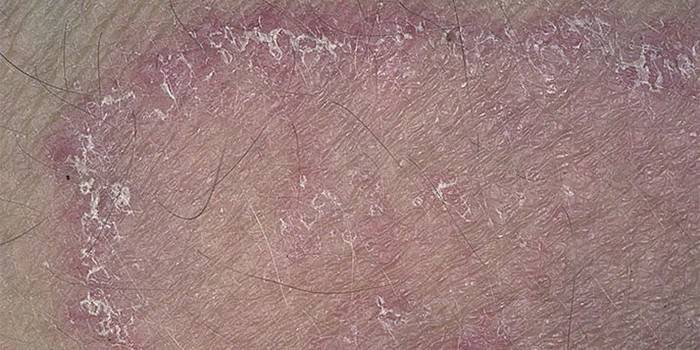 Грибковий дерматит у немовляти, дитини або дорослого - як виглядають висипання на шкірі і як лікувати