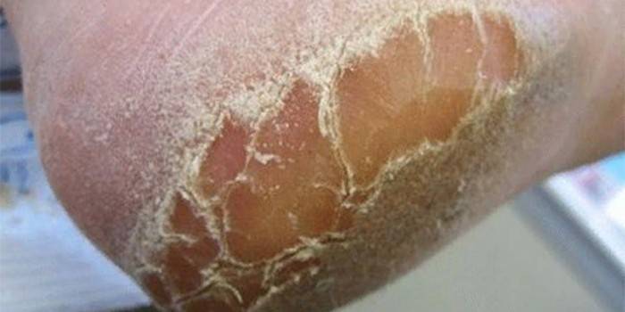 Грибок шкіри ніг - перші симптоми, причини та види хвороби, як лікувати область ураження стопи