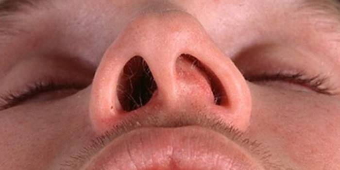 Застуда на носі у дорослого і дитини: причини і симптоми хвороби, як позбавитися від висипань в домашніх умовах