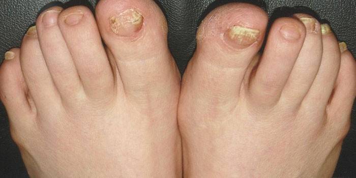 Грибок нігтів на ногах - ознаки, стадії та види хвороби: як лікувати захворювання народними і лікарськими препаратами, лазеротерапією