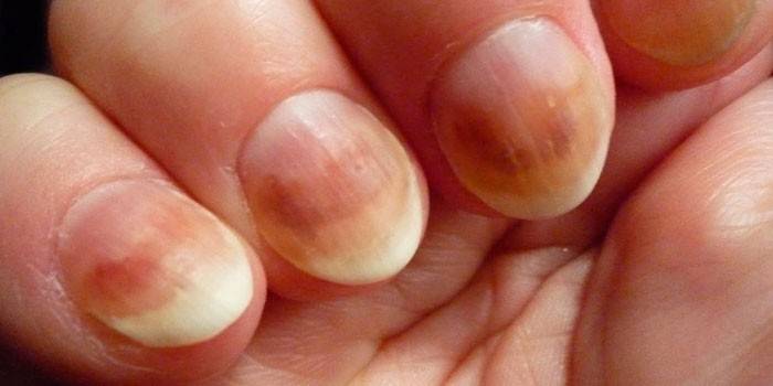 Кандидоз нігтів: причини та види хвороби, як лікувати ураження нігтьової пластини - медикаментозна терапія і народні методи