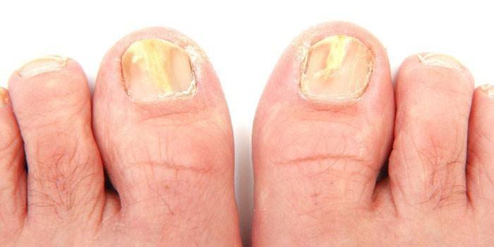 Лікування грибка нігтів йодом на ногах і руках: допомагає народне засіб від оніхомікозу