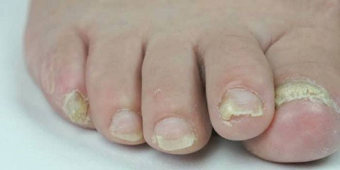 Грибок нігтів на ногах - симптоми: як визначити, як виглядає поразка