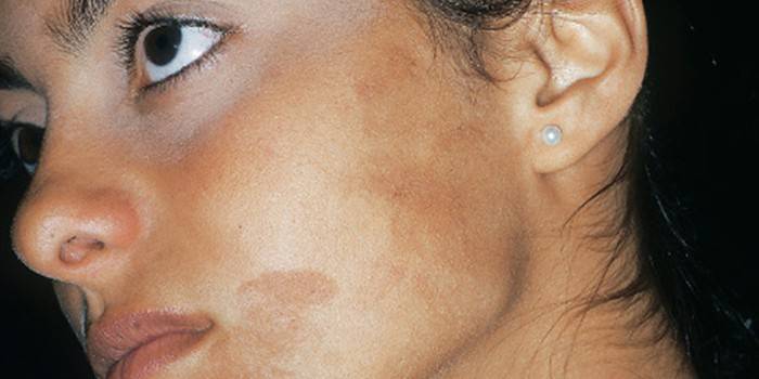 Пігментні плями на обличчі - як позбавитися: косметичні і народні засоби