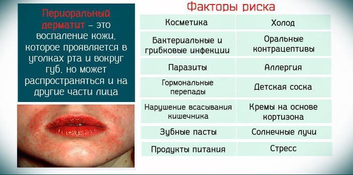 Періоральний дерматит у дорослих і дітей