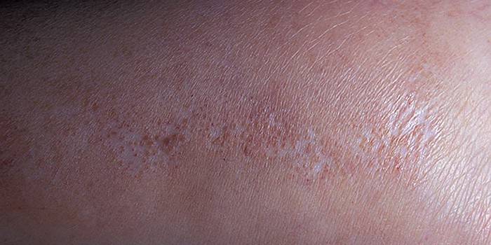 Атрофія шкіри - чому відмирають клітини і виникає стоншення епідермісу, методи і способи терапії