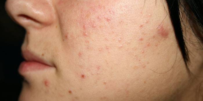 Алергія на обличчі у дорослих, засоби для швидкого лікування висипань