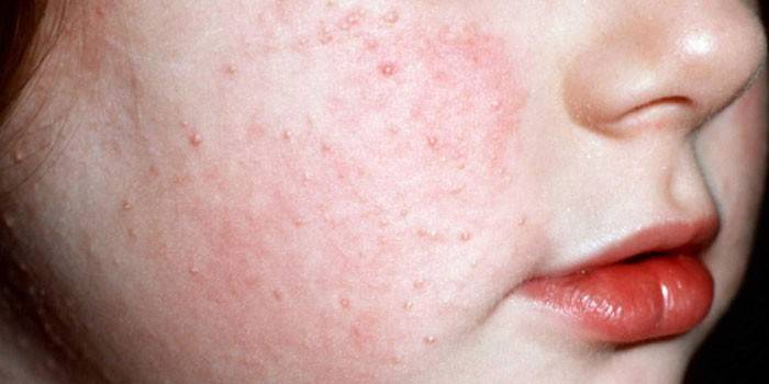 Фолікулярний гіперкератоз у дитини і дорослого - причини, симптоми, лікування шкіри кремами і мазями