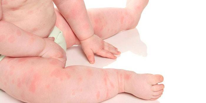 Алергія у немовлят - прояви, симптоми, визначення алергену та лікування препаратами