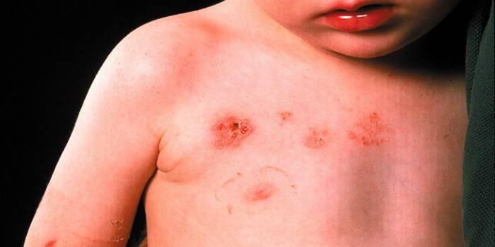 Інфекційний дерматит у дитини або дорослого - причина захворювання, симптоми, діагностика і лікування