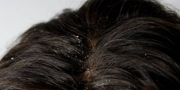 Суха себорея шкіри голови та обличчя - симптоми і лікування шампунем, народними засобами і мазями