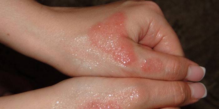 Екзематозний дерматит на руках, теле або ногах - причини виникнення, симптоми і лікування